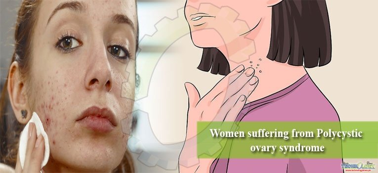 Women suffering from Polycystic ovary syndrome
