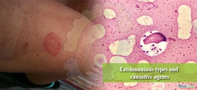 Leishmaniasis types and causative agents