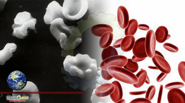 Some Medical Examiners Say Sickle Cell Trait Causes Sudden Death. They’re Wrong