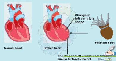 Broken-heart-syndrome-or-stress-induced-cardiomyopathy