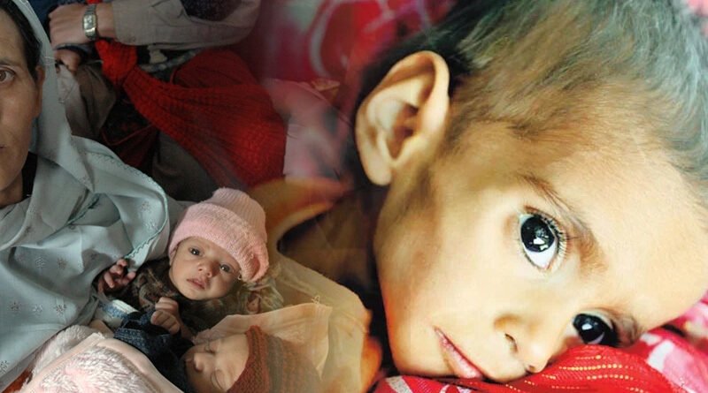 4 Out Of 10 Children In Pakistan Facing Problems Of Malnutrition