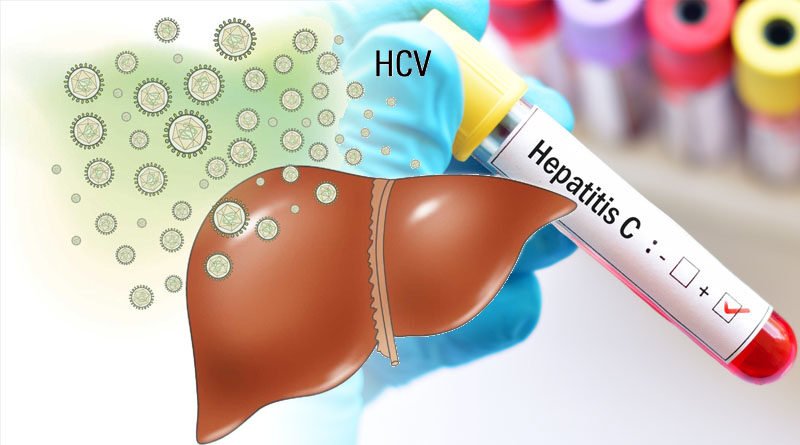Liver Infection Brings On By Hepatitis C Virus.jpg