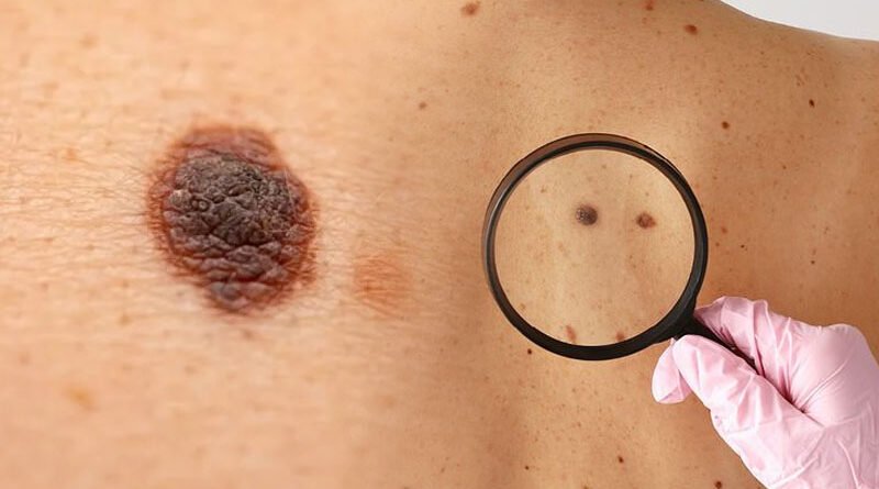 Combination therapy boosts advanced melanoma treatment: Study
